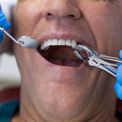 TOOTH EXTRACTION
